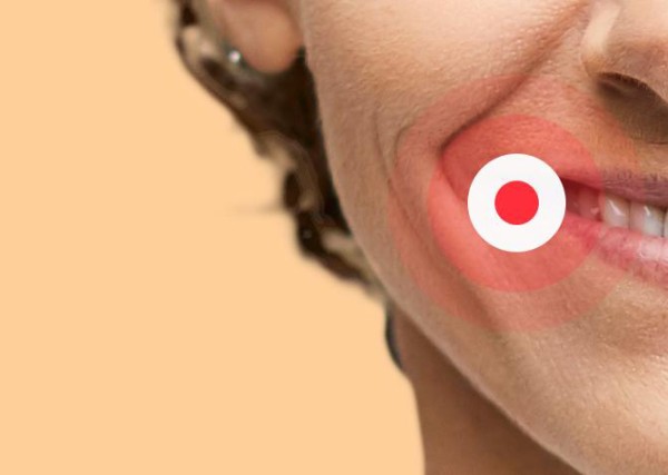 image of a smiling woman with a red circle indicating a cold sore