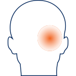 Cluster Headache